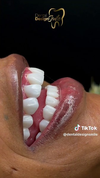 ✨ Witness the magic of your first smile moment! At Dental Design Smile, every transformation is crafted with precision, harmony, and artistry — because your smile deserves nothing less. 💎 From your first consultation to your final reveal, our team ensures a luxury experience with free VIP transportation and hotel stay in Miami. 🌴 📩 DM us “MIAMI” to begin your smile transformation today. #DentalDesignSmile #MiamiSmile #SmileTransformation #PorcelainVeneers #SmileDesign #CosmeticDentistry #Smil