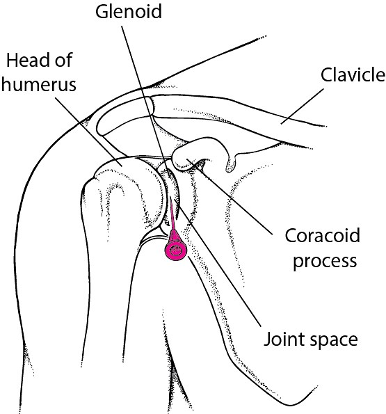 How To Do Shoulder Arthrocentesis - Rheumatology and Orthopedics - MSD Manual Professional Edition