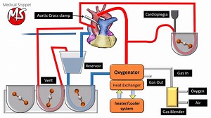 Basic Cardiopulmonary bypass circuit :) | Medical Snippet