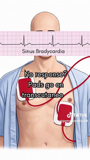 Symptomatic Bradycardia | Cardiac Dysrhythmias Song Symptomatic bradycardia?Treat the patient, not just the monitor. Understanding the ACLS approach to bradycardia is essential for nursing students and new nurses. #nursingstudent #nursingeducation #acls #paramedicoftiktok #nurse For nursing education only, not medical advice.