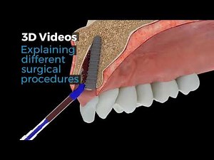 Guided Bone Regeneration iBook