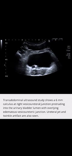 Ultrasound of Ureterovesical Junction Calculus | 6 mm Stone Protruding into Bladder