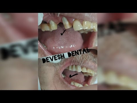 Zirconia crowns are strong, natural-looking dental restoration#dental #zirconia