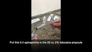 1% Lidocaine for Walant Surgery
