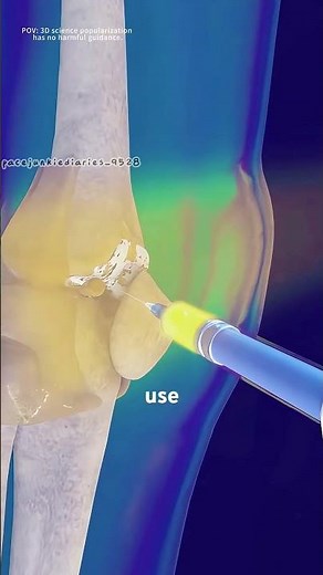 Visco gel injection for treatment of knee osteoarthritis (3D animation) #medicalanimation #skeletal