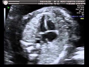 AV canal defect- complete