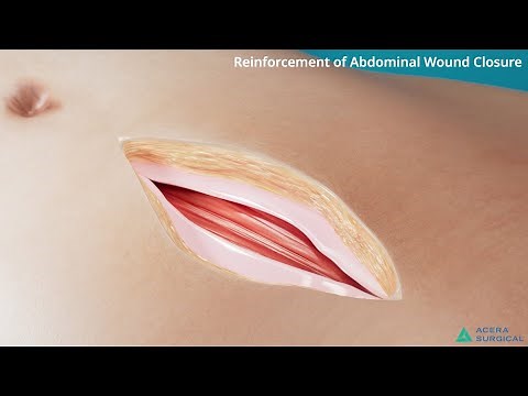 Restrata for Soft Tissue Reinforcement Surgical Technique: Reinforcement of Abdominal Wound Closure