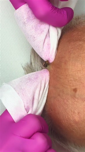 The Biggest Pimple Ever: Satisfying Extraction Video