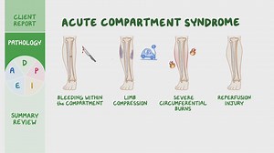 Video: Acute compartment syndrome: Nursing process (ADPIE) - Video Explanation! | Osmosis | Osmosis