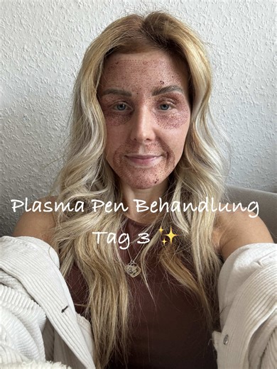 Update zur Plasma Pen Behandlung von Baby Levi