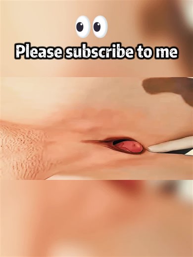 Importancia del Pessary Ring en la Salud Pélvica