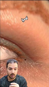 حشرة مشيت فيه عينه وهو شغال