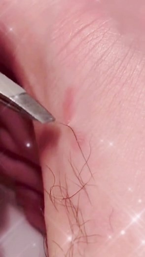 #greenscreenvideo #acneremoval #pimplepopper2021 #pimplepop #pimple #ingrownhair satisfying