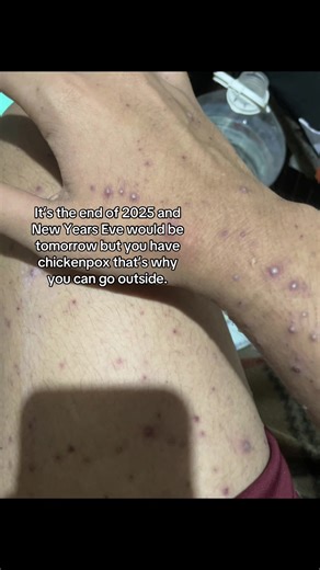 Overcoming Chickenpox: A Healing Journey