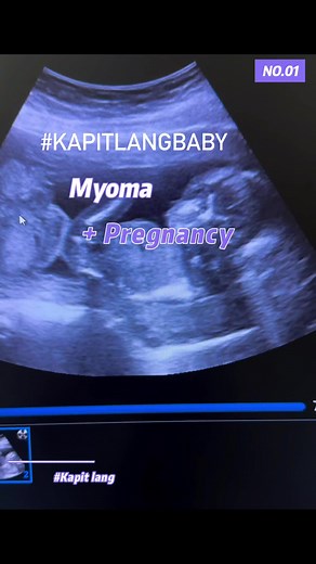 Myoma & Pregnancy chronicles. #ObGynlife #ObGynUltrasoundSubspecialist #Pregnancyjoirney #Myoma #ObGynUltrasound | Snippets of OBGYN Life