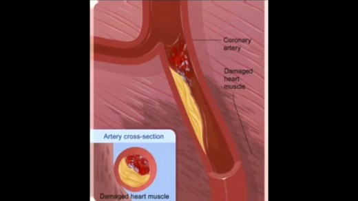 Myocardial Infarction - Heart Attack - Animation