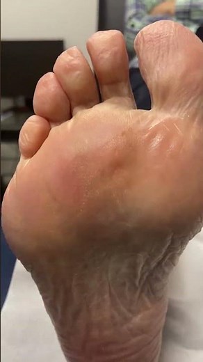 "Say goodbye to that pesky corn on your foot with this easy removal hack! Discover the satisfying