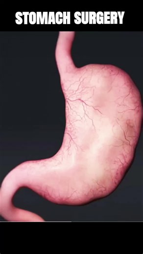 Understanding Stomach Surgery: What You Need to Know