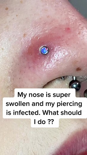 Swollen Nose Piercing: Causes, Symptoms, and Remedies
