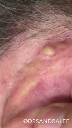 VERY nice and easy... ✌️❤️💥 #drpimplepopper #popaholics