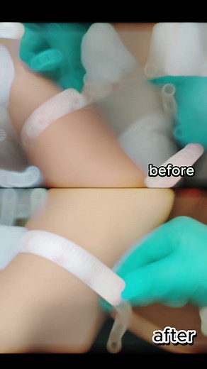 17K views · 148 reactions | Can't believe the difference! Come and get the perfect Barbie Arm with 2Z Skin Clinic! #BarbieArms #SculptAndDefine#ArmTransformation #TonedArms | 2Z Skin Clinic | Facebook