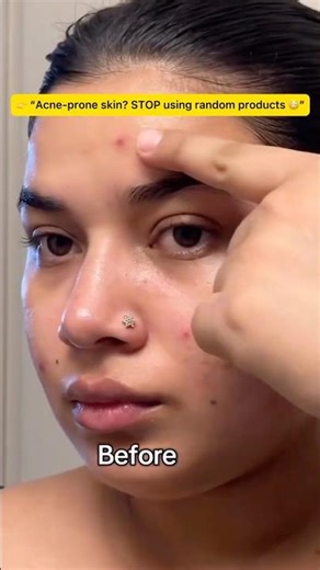 Acne-prone skin? STOP using random products