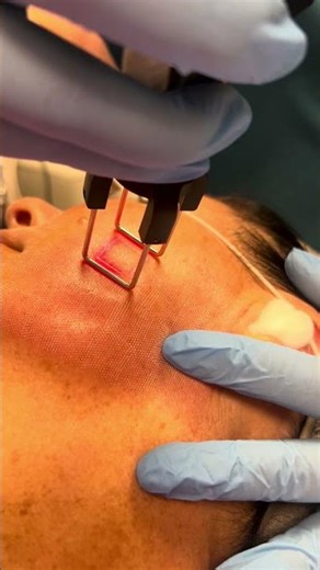 CO2 CoolPeel Laser ✨ Minimal Downtime Glow | Plymouth MI ‪@Beautispot‬