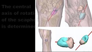 Scaphoid percutaneous fixation with Augmented Reality.