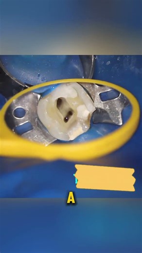 Saving a Dead Tooth: RCT Process Explained! #shorts #teeth #dentist