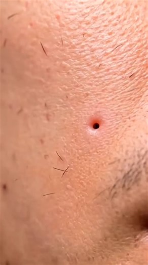 ASMR video #viraltiktok #blackheadremoval #asmrsounds #asmrvideo #tiktokusa🇺🇸