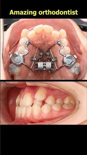 Jaw expansion using orthodontic appliances and combined with braces to straighten teeth #braces