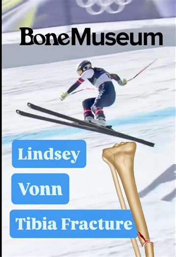Understanding Lindsey Vonn's Tibial Fracture