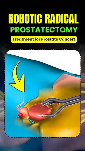 Robotic Radical Prostatectomy for Prostate Cancer | Advanced Surgery Explained by Dr. Amit Aggarwal
