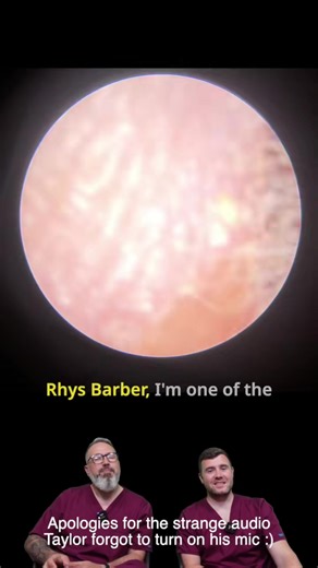 Shocking Wax Plug Removed From Nervous Patient - EP1160 Wait until you see what we pulled out In today’s video, audiologists Rhys Barber and Taylor Greene tackle two challenging cases