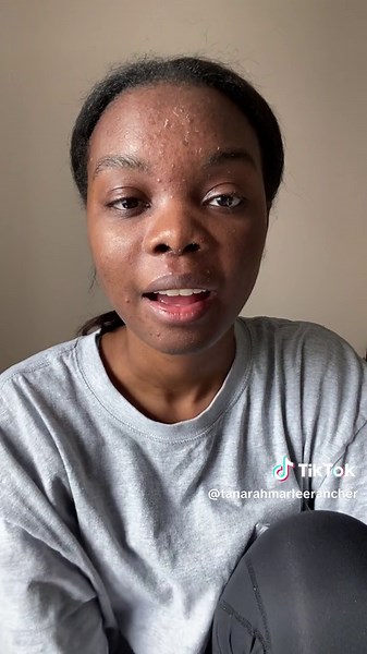 Arazlo Review: My Acne Journey and Skincare Update