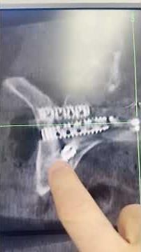 Minimally Invasive Sacroiliac Joint Fusion