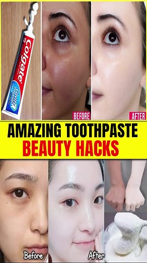 Get Glowing Skin in 1 Hour with Toothpaste! #SkinWhiteningHacks