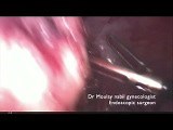 Safe and Bloodless Myomectomy for Beginners • Video • MEDtube.net