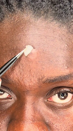 Best pimple patches for acne: how acne patches work