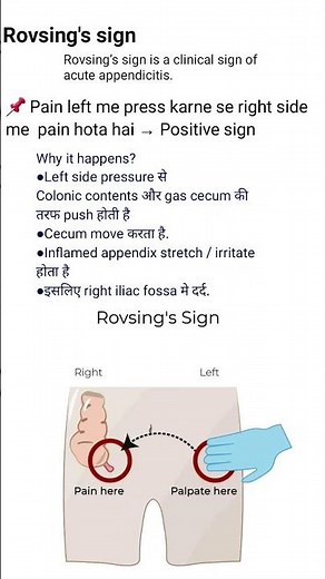 Rovsing's sign | Appendicitis
