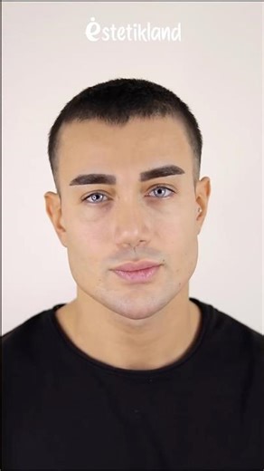 Jawline | Çene Dolgusu | Estetikland Poliklinik