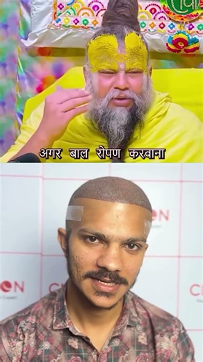 Hair Transplant Information: Procedure, Growth Timeline, and Natural Results