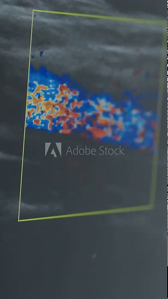 color Doppler ultrasound showing arterial flow grayscale soft tissue background, color box highlights blue and red flow, cine frames reveal changing waveform and velocity sonographer maneuvers