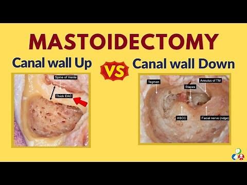 Canal wall up VS Canal wall down Mastoidectomy | Differences