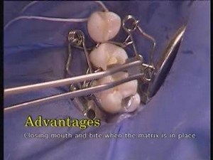 Walser® Sectional Matrix: User film into tooth doctor's practice