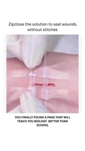 BIOLOGY | MEDICAL | HEALTH on Instagram: "Zip-type wound closures, like “Zip Stitch,” offer a non-invasive alternative to traditional stitches for certain wounds. These closures, which often involve adhesive strips and a “zipper” mechanism, can be used for lacerations and surgical incisions. They are designed to distribute strain along the wound, potentially reducing complications and scarring compared to sutures. Dm for credit or removal👏🏻 #viral #viralreels #medical #mbbs #mbbstudent"