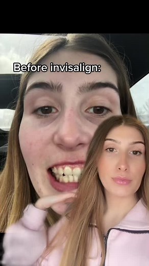 Transforming Smiles with Invisalign Before and After