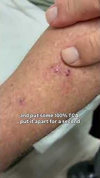 Dermatologist with 50 years experience shows removal of scab like precancerous lesions👨🏻‍⚕️