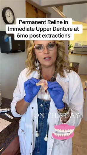 #onthisday #dentures #denturist #dentaltok #falseteeth Permanent denture reline, 6mos post extraction day.