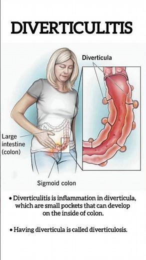 Diverticulitis I Colonic diverticula treatment in Delhi Noida